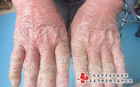 [到长春看牛皮癣哪家医院比较好]牛皮癣患者在秋季要注意哪些问题?