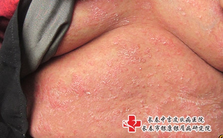 [吉林长春的牛皮癣治疗医院有哪家]牛皮癣的四大类型症状是什么?