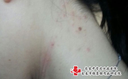 不得限制购买退热等药物？长春治疗青春痘比较好的医院是哪家