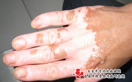 弱阳性几天可以转阴?长春如何选择白癜风医院