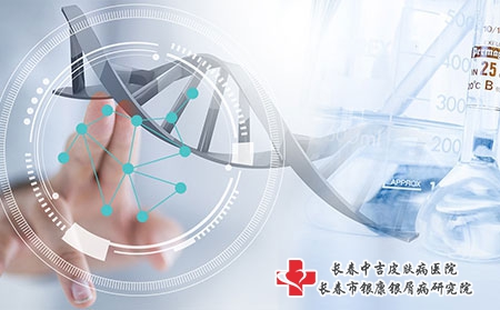 激素药对牛皮癣的效果有多快【长春中吉医院看病可靠】