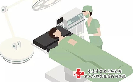 激素药对牛皮癣的效果有多快【长春中吉医院看病可靠】