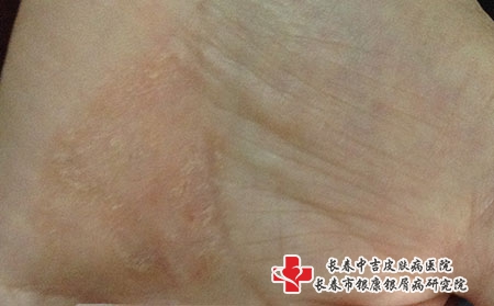 [长春皮肤病医院]专家号-长春皮肤病医院预约治疗湿疹的专家
