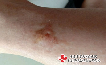 长春引起皮肤过敏的原因，长春治疗过敏专科