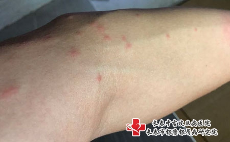 长春皮肤过敏患者的饮食禁忌，长春专治过敏的医院