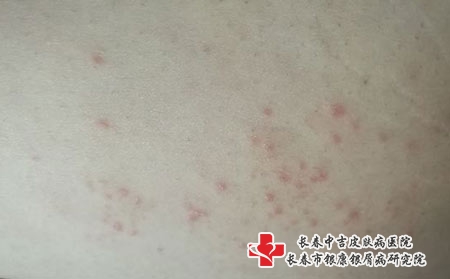 长春如何预防儿童药物性皮炎，长春治疗皮炎医院有哪些