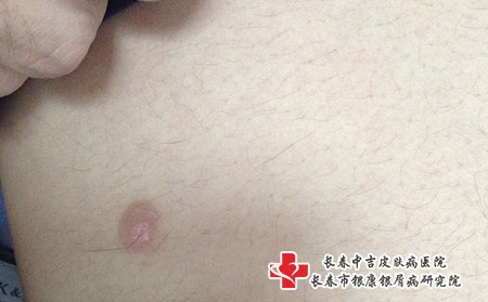 长春哪里治疗白癜风好，长春治疗白癜风權威的医院