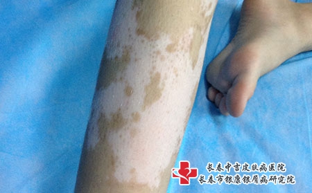 长春哪里治疗白癜风效果好，长春专治白癜风的医院