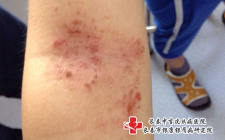 长春湿疹患者日常该注意些什么，长春专治湿疹的医院