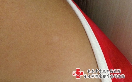 长春治疗白癜风效果好的医院，长春治疗白癜风专科哪家好