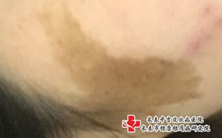 吉林看胎记医院排名哪家好，长春专治胎记的医院