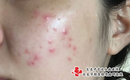 长春青春痘医院哪个好，长春治疗痤疮专科