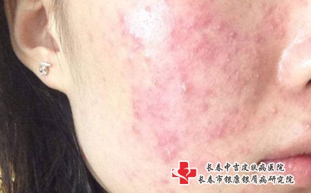 长春治疗青春痘的医院哪家好，长春治疗痤疮专科哪家好