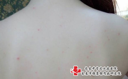 长春治青春痘的医院，长春痤疮哪家治疗好