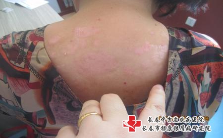 长春银屑病是什么样的，长春治疗牛皮癣专科