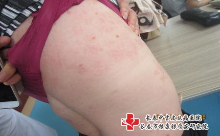 长春银屑病都有哪些症状表现,长春牛皮癣哪家治疗好 长春银屑病都有哪些症状表现,长春牛皮癣哪家治疗好