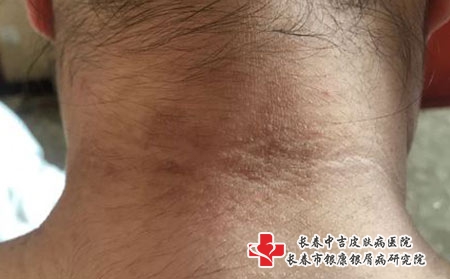 长春如何治疗面部皮炎，长春专治皮炎的医院