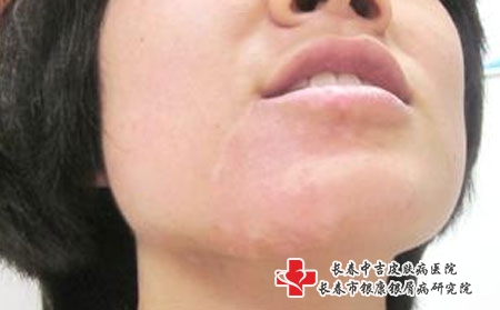 长春白癜风的护理，长春白癜风哪家医院看的好