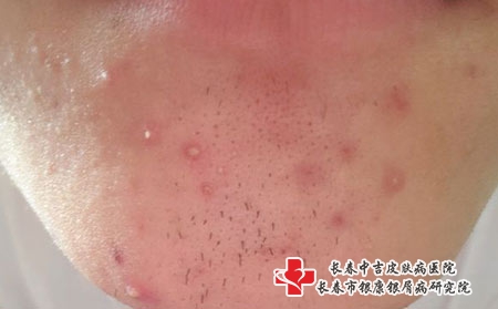 长春治疗青春痘的费用是多少，长春治疗痤疮医院排行?