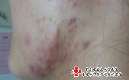 长春治疗青春痘哪家医院比较好，长春治疗痤疮權威的医院