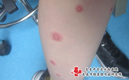 长春要遵守哪些治疗原则,长春治疗牛皮癣专科哪家好 长春要遵守哪些治疗原则,长春治疗牛皮癣专科哪家好