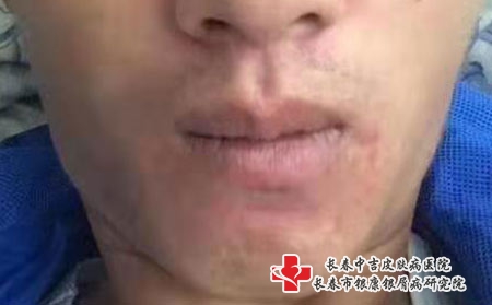 长春怎样有效的预防过敏性皮炎?长春治疗皮炎专科