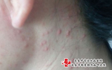 长春治疗青春痘的医院，长春治疗痤疮医院排行?