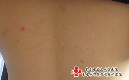 长春花多少才能治好荨麻疹，长春治疗荨麻疹医院有哪些