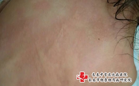 长春治荨麻疹医院那一家比较好，长春治疗荨麻疹医院有哪家呢