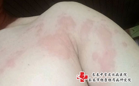 长春治疗孩子荨麻疹到哪好，长春治疗荨麻疹医院排行?