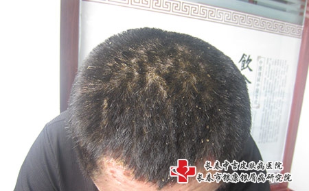 长春牛皮癣发病初期什么样,长春治疗牛皮癣专科 长春牛皮癣发病初期什么样,长春治疗牛皮癣专科