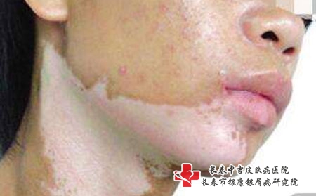 长春要怎么治顽固白癜风，长春白癜风哪家治疗好
