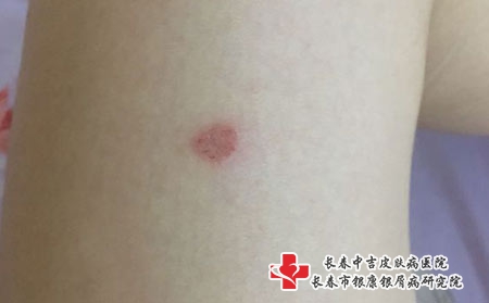 看皮肤过敏长春哪家医院好，长春过敏哪家医院看的好