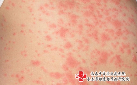 长春皮肤过敏该要怎么护理，长春过敏哪家治疗好