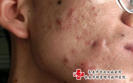 长春治疗青春痘的医院哪家好，长春痤疮哪家医院看的好
