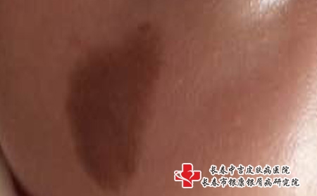长春胎记医院，青胎记早期有哪些症状