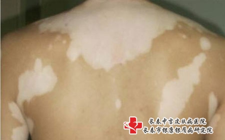 颈部白癜风疾病的治疗要怎么做，长春白癜风哪家医院看的好