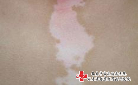 如何治疗正在扩散的白癜风，长春治疗白癜风专科哪家好