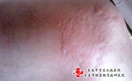 皮肤过敏应该要怎么护理，长春治疗过敏专业医院