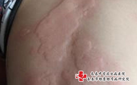 在长春看皮肤过敏要多少钱，长春专治过敏的医院