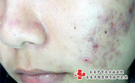 粉刺形成的原因有哪些，长春治疗痤疮要花多少钱