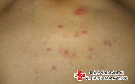 粉刺的临床症状有哪些，长春治疗痤疮權威的医院