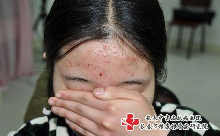 哪些原因会导致长青春痘，长春治疗痤疮专科
