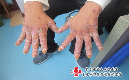 长春牛皮癣有什么治疗方法，长春治疗牛皮癣要花多少钱