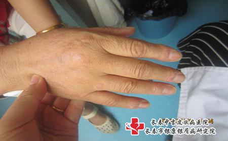 牛皮癣饮食注意事项，长春怎么治疗牛皮癣才能有效?