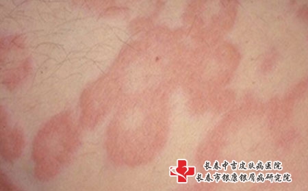 长春看皮炎去哪个医院好，长春专治皮炎的医院