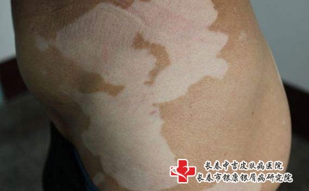 手部白癜风怎么治疗，长春治疗白癜风医院有哪家呢