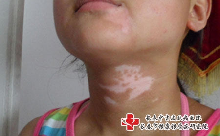 女性脖子上长不明显的白癜风怎么，长春白癜风哪家治疗好