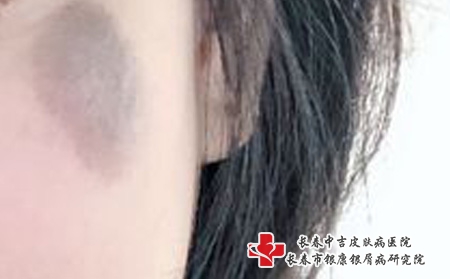 长春哪家医院去除红色胎记好，长春胎记哪家医院看的好