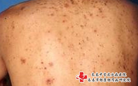 女性患上痤疮的原因哪些，长春专治痤疮的医院